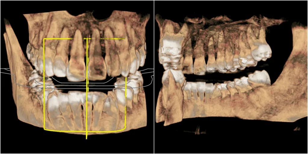 a 3D rendering taken from the Sirona Orthophos XG machine of someone's dental anatomy